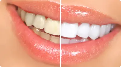 Invisalign Cedar City


